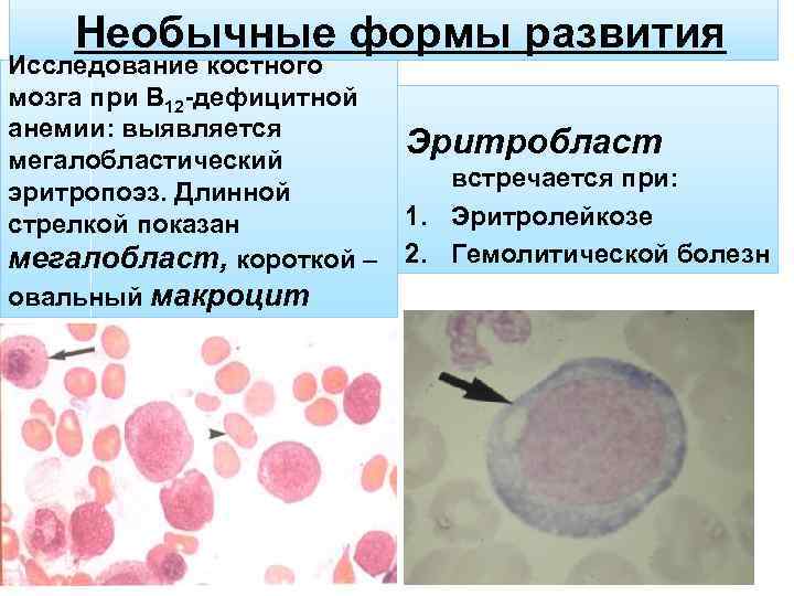 Необычные формы развития Исследование костного мозга при В 12 -дефицитной анемии: выявляется мегалобластический эритропоэз.