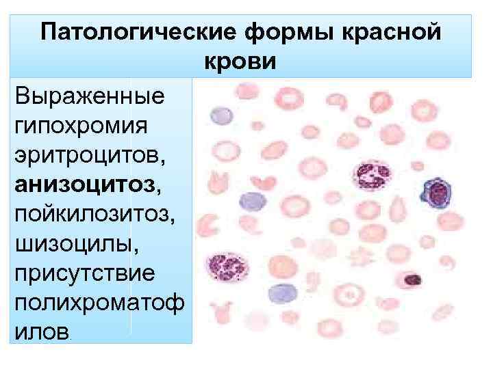 Патологические формы красной крови Выраженные гипохромия эритроцитов, анизоцитоз, пойкилозитоз, шизоцилы, присутствие полихроматоф илов. 