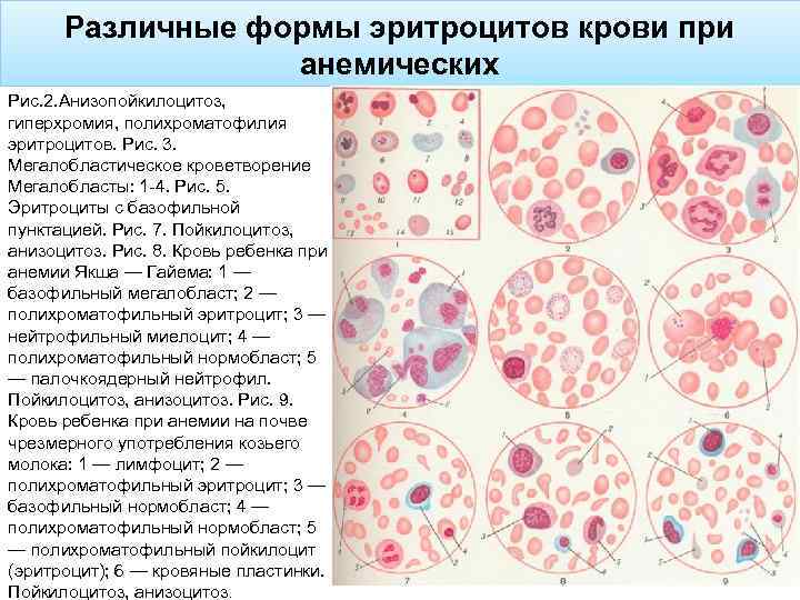 Различные формы эритроцитов крови при анемических Рис. 2. Анизопойкилоцитоз, гиперхромия, полихроматофилия эритроцитов. Рис. 3.