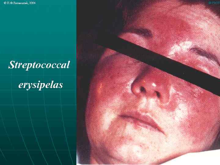 © П. Ф. Литвицкий, 2004 Streptococcal erysipelas © ГЭОТА 