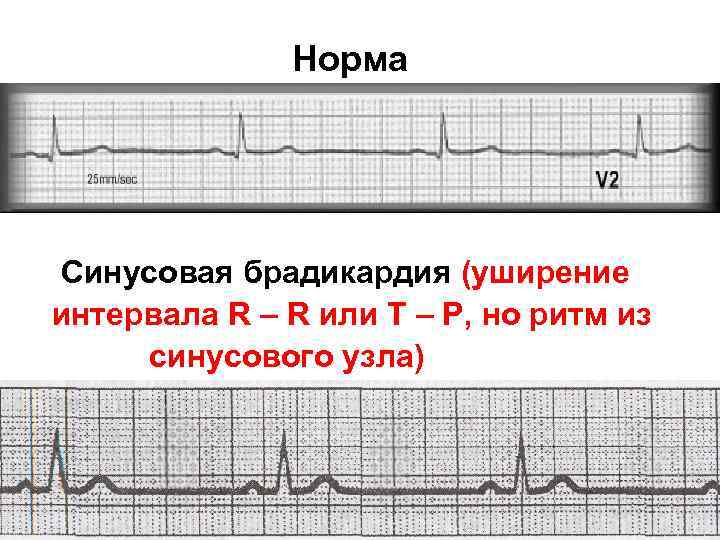 Норма Синусовая брадикардия (уширение интервала R – R или T – P, но ритм