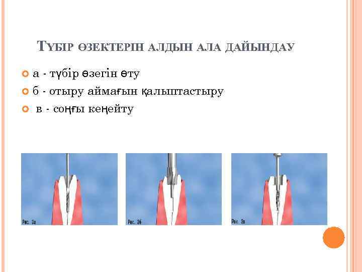 ТҮБІР ӨЗЕКТЕРІН АЛДЫН АЛА ДАЙЫНДАУ а - түбір өзегін өту б - отыру аймағын