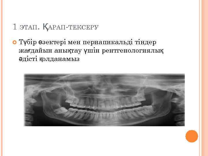 1 ЭТАП. ҚАРАП-ТЕКСЕРУ Түбір өзектері мен периапикальді тіндер жағдайын анықтау үшін рентгенологиялық әдісті қолданамыз