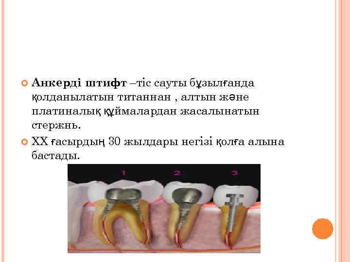 Анкерді штифт –тіс сауты бұзылғанда қолданылатын титаннан , алтын және платиналық құймалардан жасалынатын стержнь.