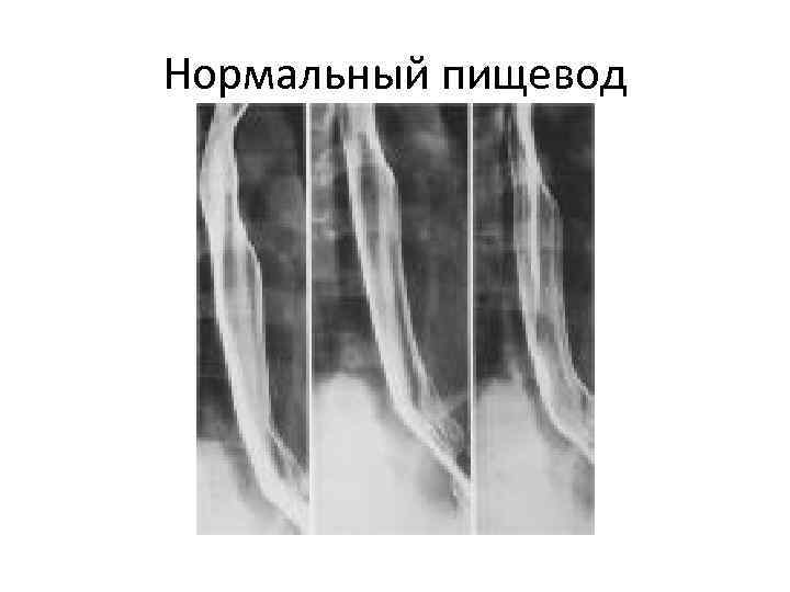 Нормальный пищевод 