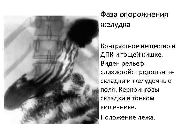 Фаза опорожнения желудка Контрастное вещество в ДПК и тощей кишке. Виден рельеф слизистой: продольные