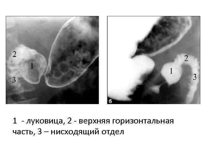 1 луковица, 2 верхняя горизонтальная часть, 3 – нисходящий отдел 