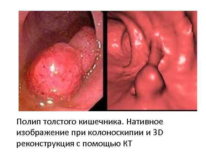 Полип толстого кишечника. Нативное изображение при колоноскипии и 3 D реконструкция с помощью КТ