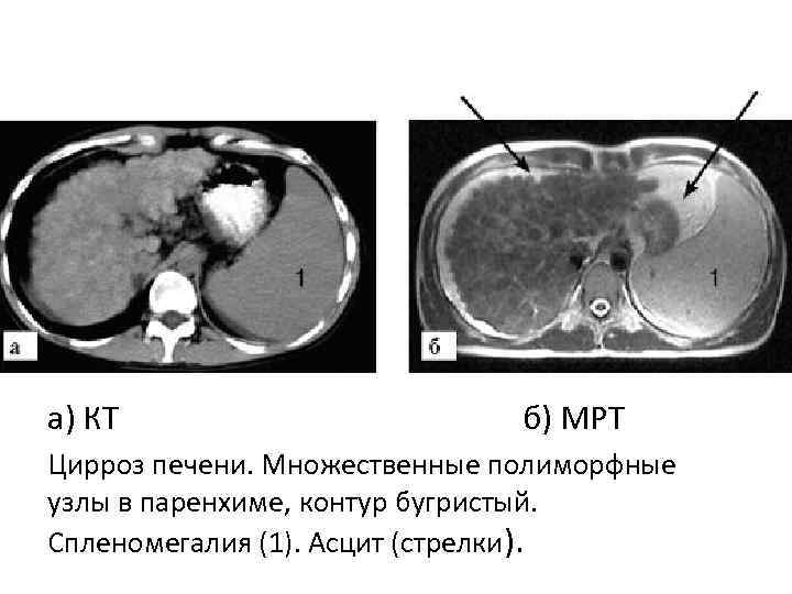 а) КТ б) МРТ Цирроз печени. Множественные полиморфные узлы в паренхиме, контур бугристый. Спленомегалия