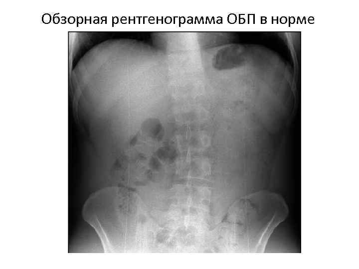 Обзорная рентгенограмма ОБП в норме 