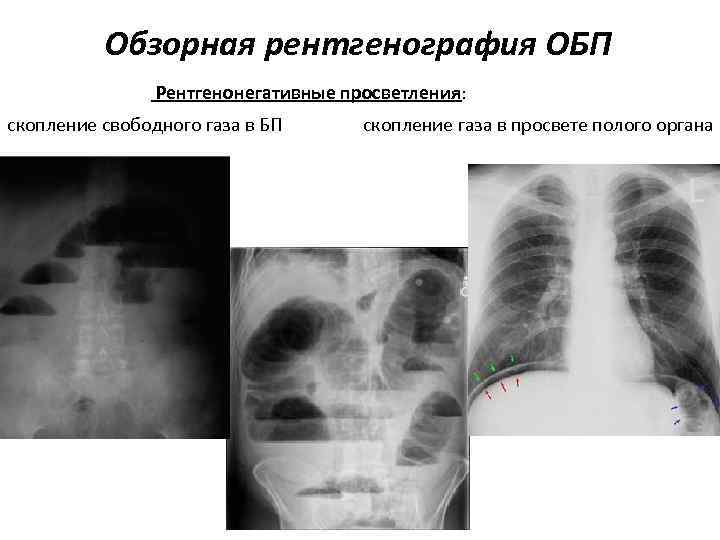 Рентгенография органов брюшной полости. Рентген ОБП на Свободный ГАЗ. Рентгенонегативные. Рентгенонегативные контрастные рентгенограмма. Свободный ГАЗ при обзорной рентгенографии.