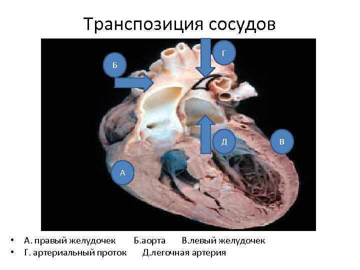 Транспозиция артерий