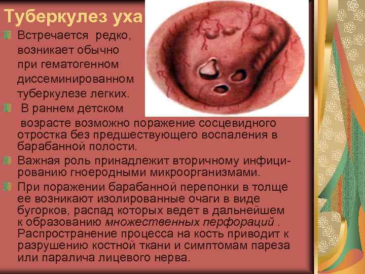 Туберкулез уха Встречается редко, возникает обычно при гематогенном диссеминированном туберкулезе легких. В раннем детском