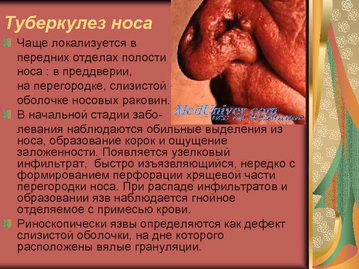 Туберкулез носа Чаще локализуется в передних отделах полости носа : в преддверии, на перегородке,