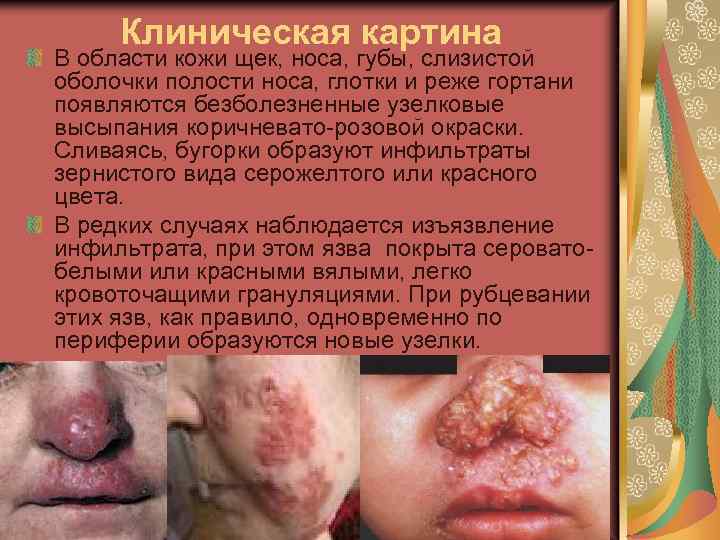 Клиническая картина В области кожи щек, носа, губы, слизистой оболочки полости носа, глотки и