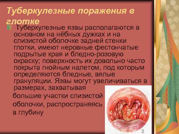 Туберкулезные поражения в глотке Туберкулезные язвы располагаются в основном на нёбных дужках и на