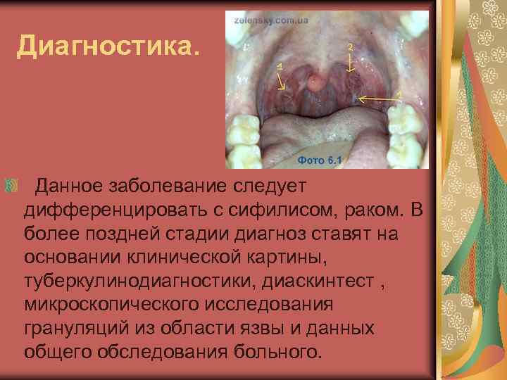 Диагностика. Данное заболевание следует дифференцировать с сифилисом, раком. В более поздней стадии диагноз ставят