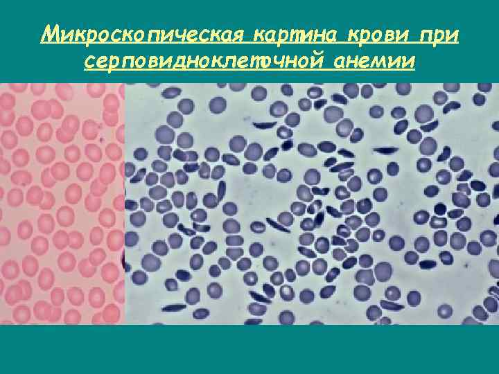 Микроскопическая картина крови при серповидноклеточной анемии 