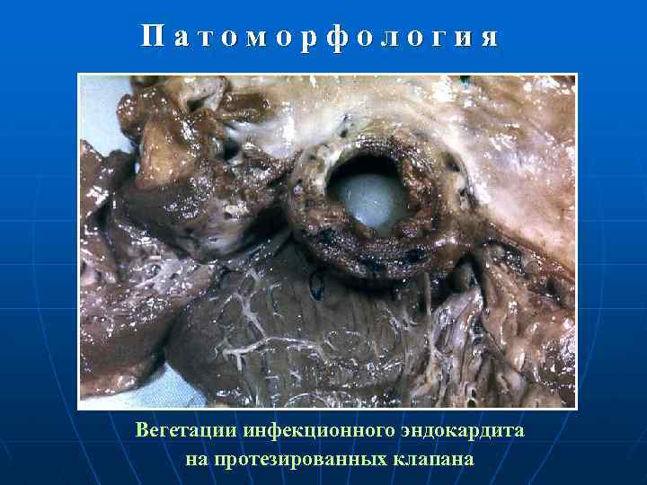 Патоморфология Вегетации инфекционного эндокардита на протезированных клапана 