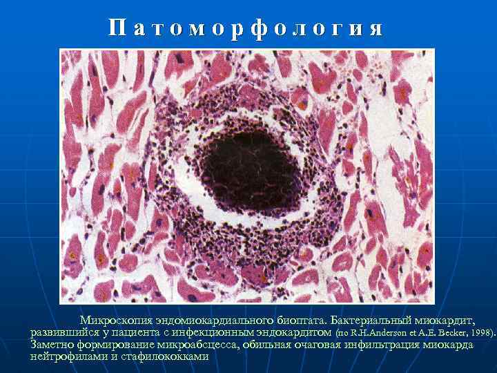 Патоморфология Микроскопия эндомиокардиального биоптата. Бактериальный миокардит, развившийся у пациента с инфекционным эндокардитом (по R.