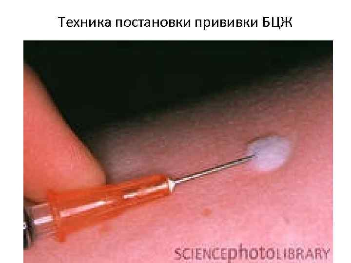 Техника постановки прививки БЦЖ 