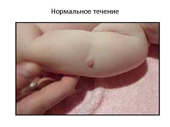 Нормальное течение 