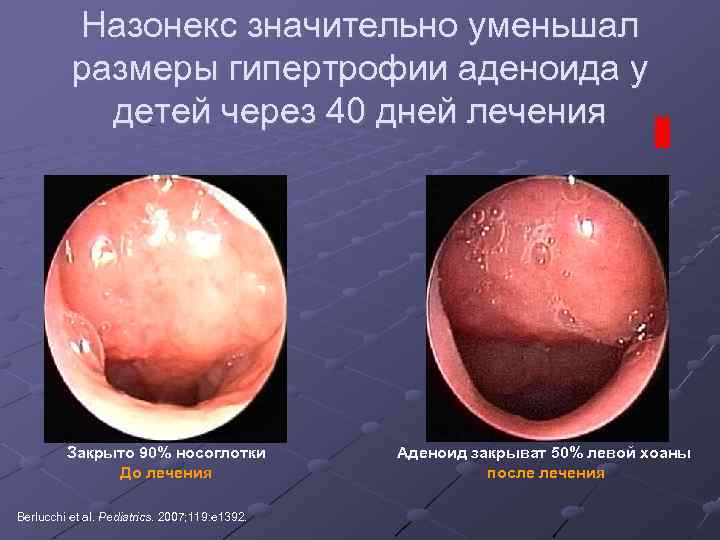 Назонекс значительно уменьшал размеры гипертрофии аденоида у детей через 40 дней лечения Закрыто 90%