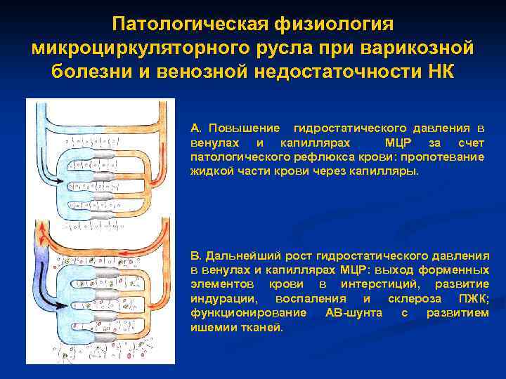 Патологическая физиология микроциркуляторного русла при варикозной болезни и венозной недостаточности НК А. Повышение гидростатического
