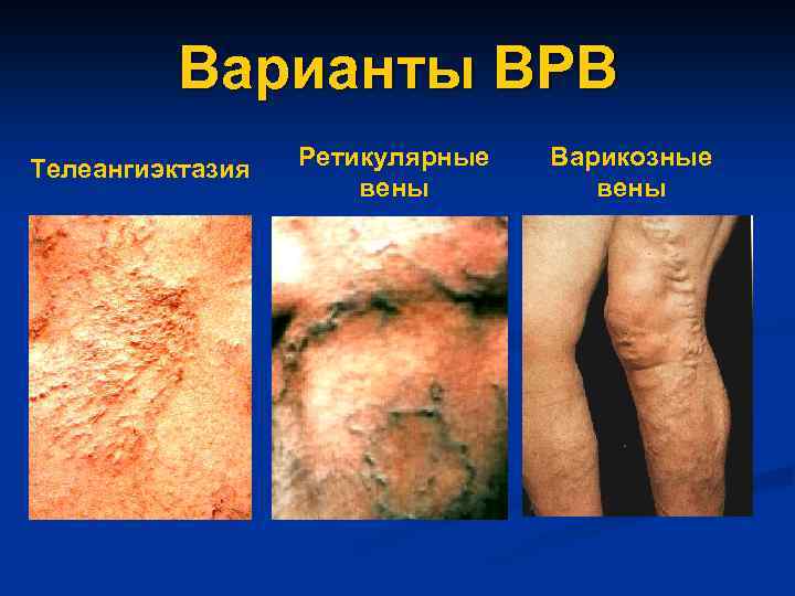 Варианты ВРВ Телеангиэктазия Ретикулярные вены Варикозные вены 