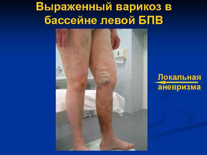 Выраженный варикоз в бассейне левой БПВ Локальная аневризма 