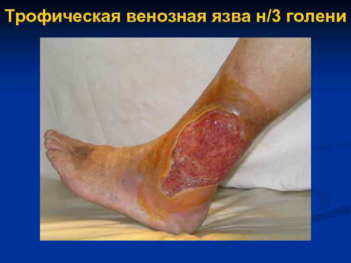 Трофическая венозная язва н/3 голени 