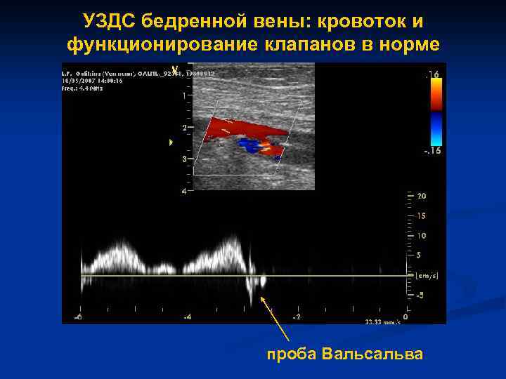 УЗДС бедренной вены: кровоток и функционирование клапанов в норме проба Вальсальва 