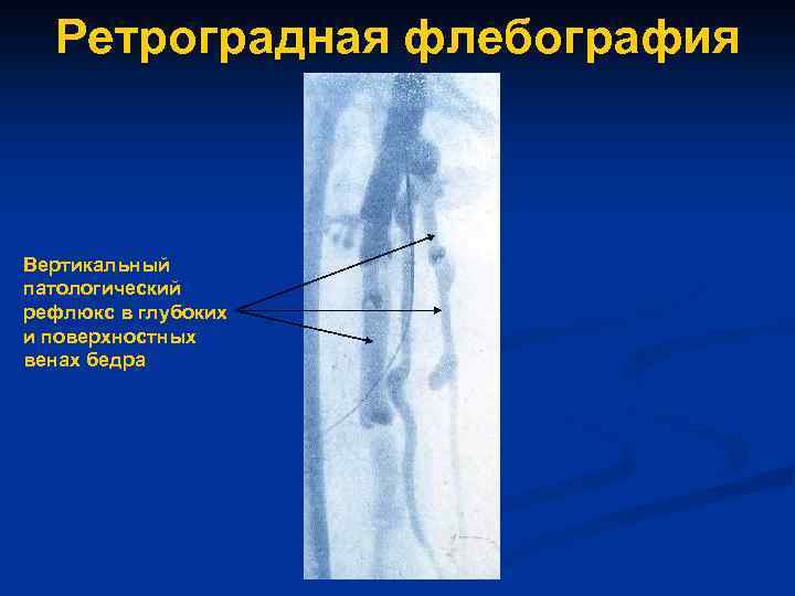 Ретроградная флебография Вертикальный патологический рефлюкс в глубоких и поверхностных венах бедра 