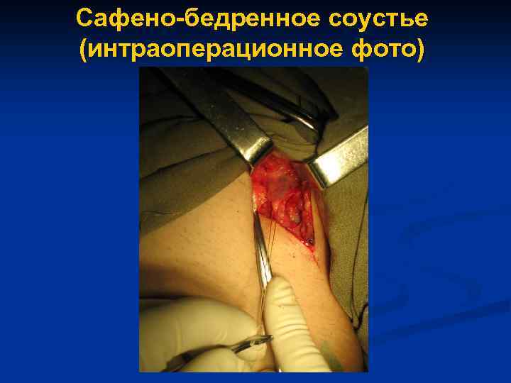 Сафено-бедренное соустье (интраоперационное фото) 