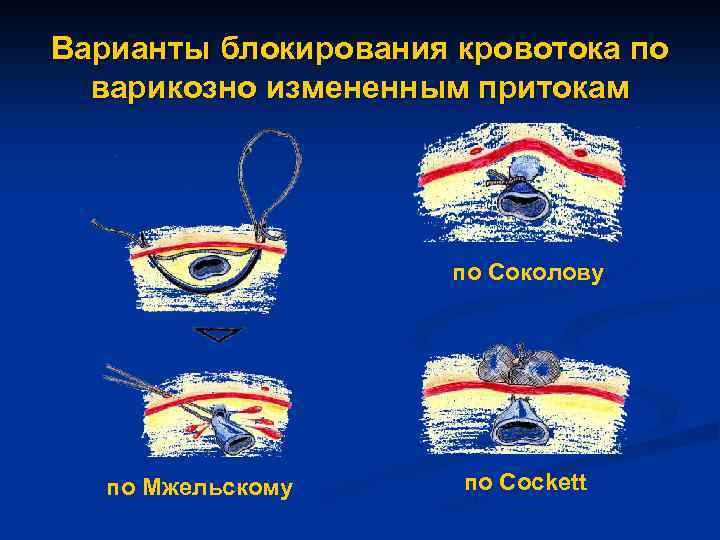Варианты блокирования кровотока по варикозно измененным притокам по Соколову по Мжельскому по Cockett 
