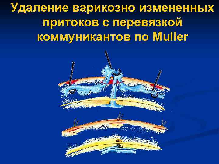 Удаление варикозно измененных притоков с перевязкой коммуникантов по Muller 