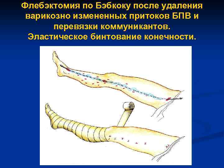 Флебэктомия по Бэбкоку после удаления варикозно измененных притоков БПВ и перевязки коммуникантов. Эластическое бинтование