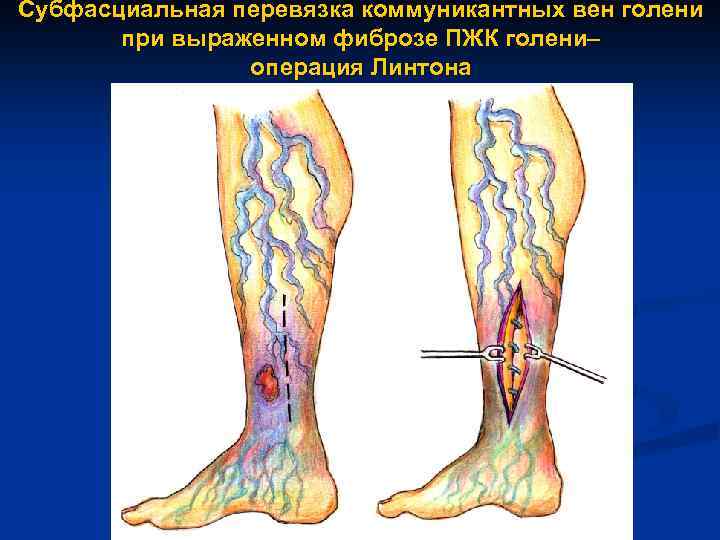 Субфасциальная перевязка коммуникантных вен голени при выраженном фиброзе ПЖК голени– операция Линтона 