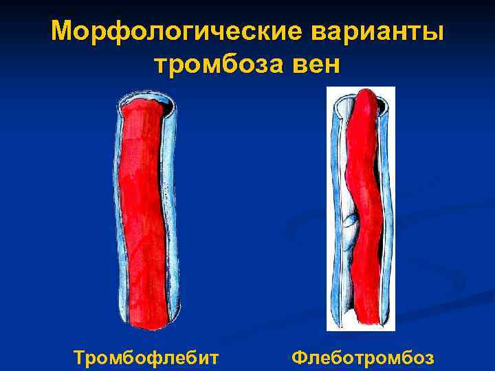 Морфологические варианты тромбоза вен Тромбофлебит Флеботромбоз 