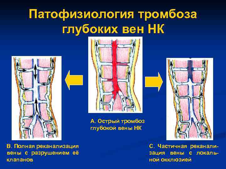 Патофизиология тромбоза глубоких вен НК А. Острый тромбоз глубокой вены НК В. Полная реканализация