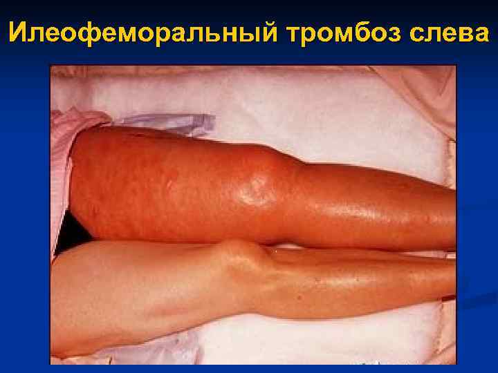 Илеофеморальный тромбоз слева 