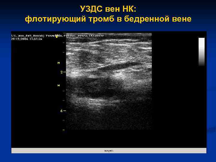 УЗДС вен НК: флотирующий тромб в бедренной вене 