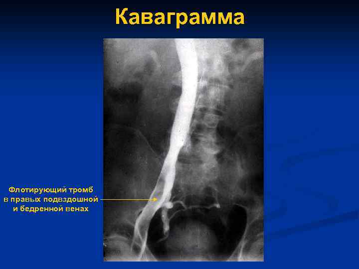 Каваграмма Флотирующий тромб в правых подвздошной и бедренной венах 