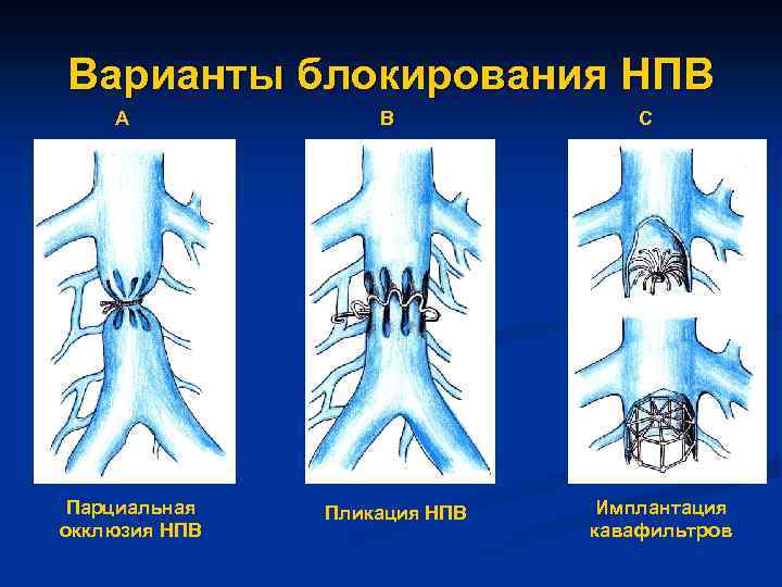 Варианты блокирования НПВ А Парциальная окклюзия НПВ В Пликация НПВ С Имплантация кавафильтров 