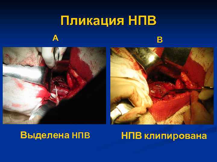 Пликация НПВ А Выделена НПВ В НПВ клипирована 