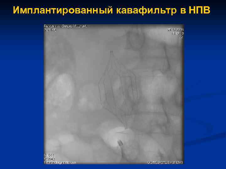 Имплантированный кавафильтр в НПВ 