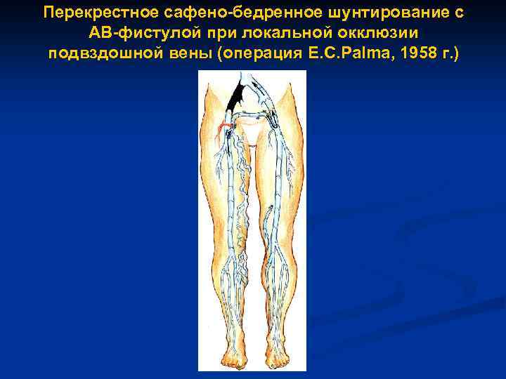 Перекрестное сафено-бедренное шунтирование с АВ-фистулой при локальной окклюзии подвздошной вены (операция E. C. Palma,