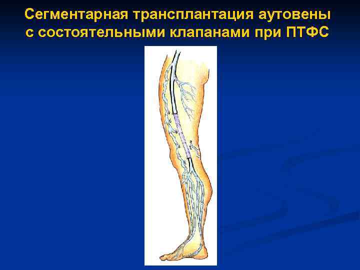 Сегментарная трансплантация аутовены с состоятельными клапанами при ПТФС 