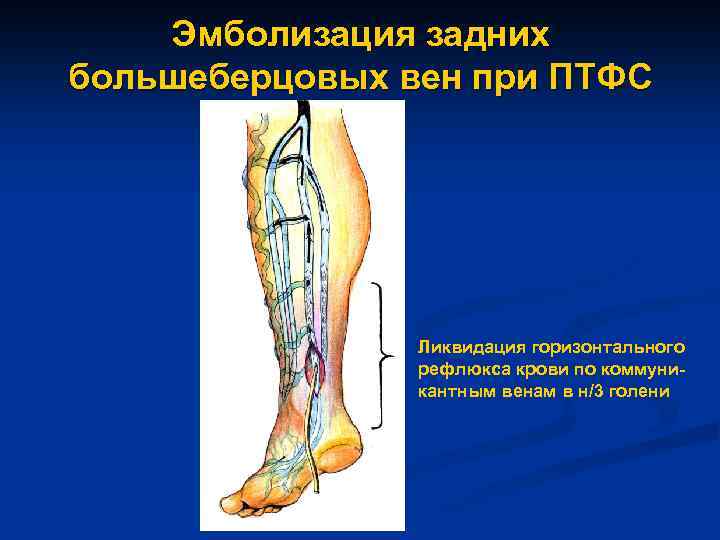 Эмболизация задних большеберцовых вен при ПТФС Ликвидация горизонтального рефлюкса крови по коммуникантным венам в