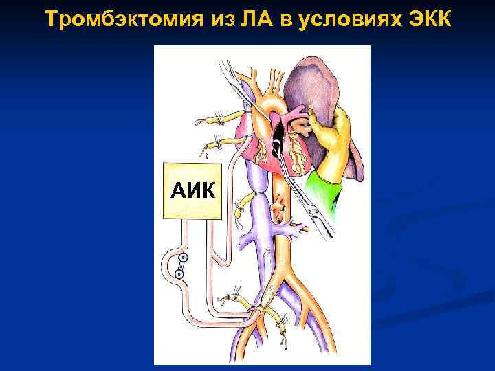 Тромбэктомия из ЛА в условиях ЭКК АИК 
